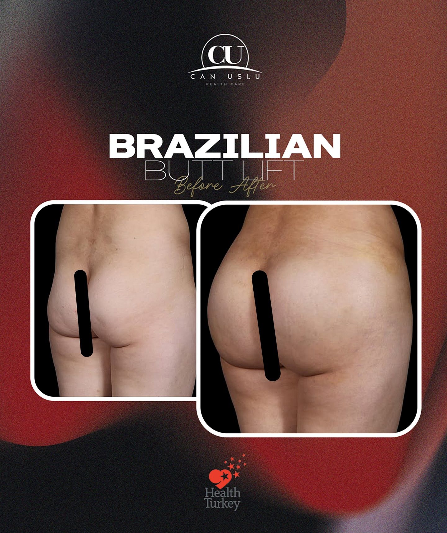 Brazilian Butt Lift öncesi sonrası
