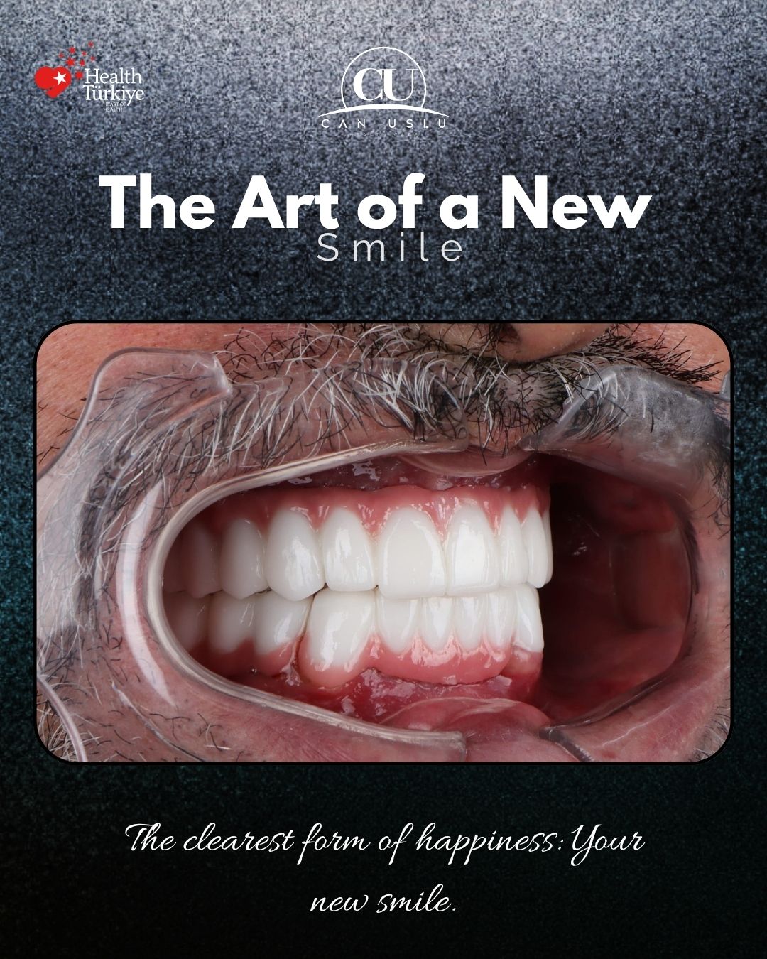 Hollywood Smile öncesi sonrası