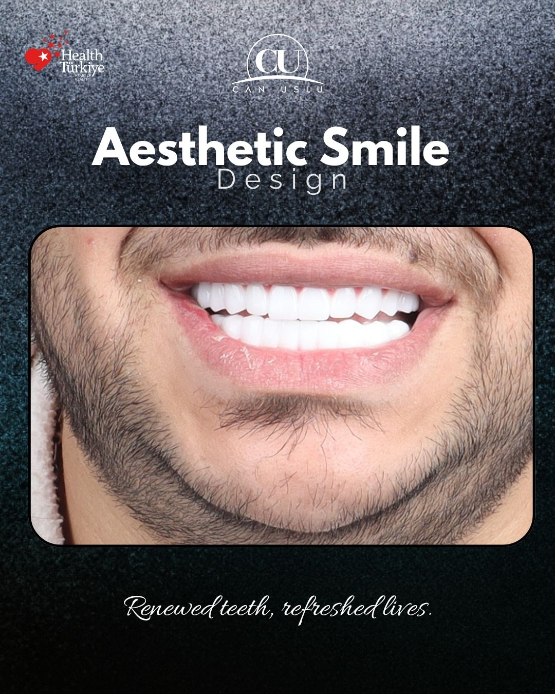 Hollywood Smile öncesi sonrası