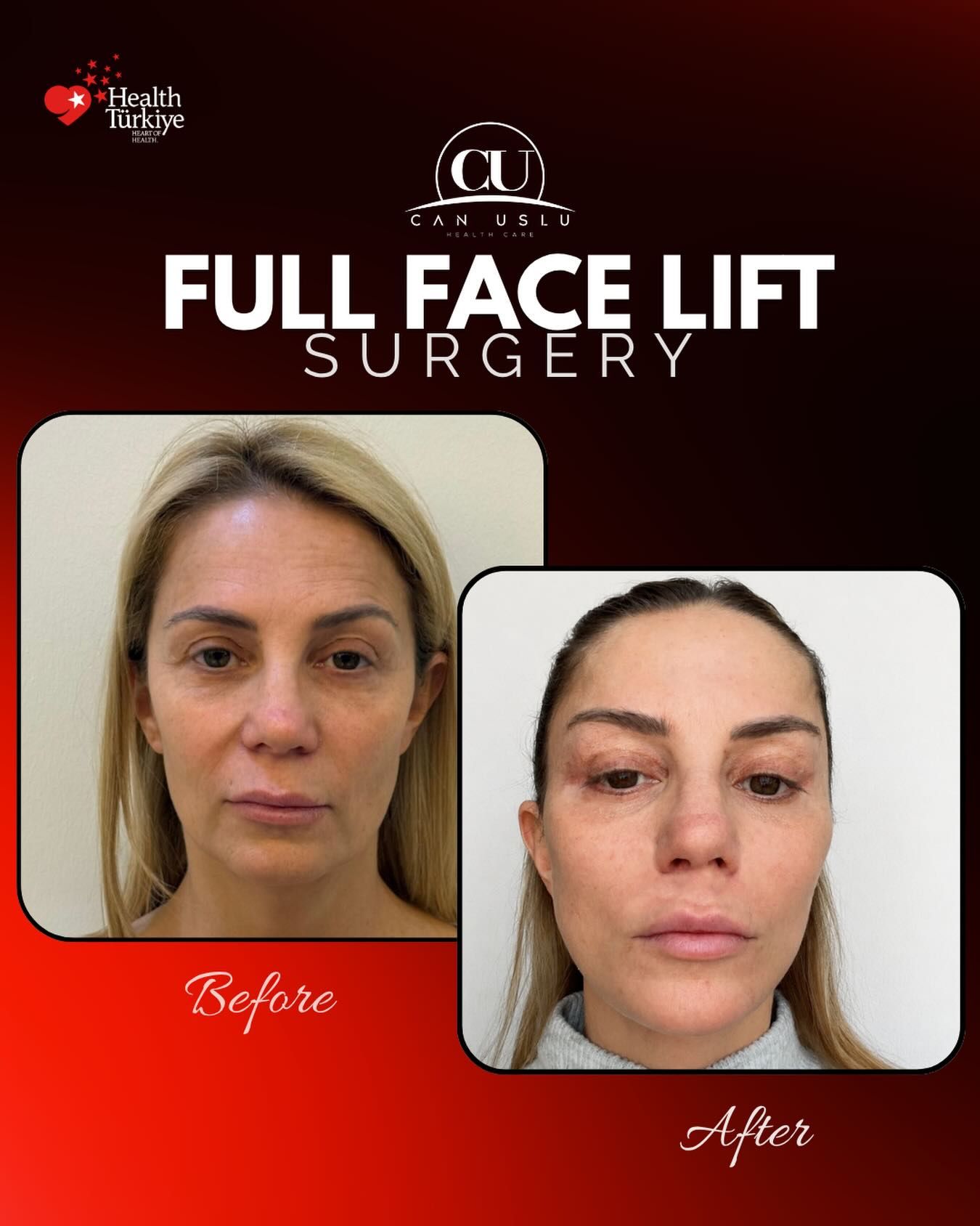 Deep Plane Facelift öncesi sonrası