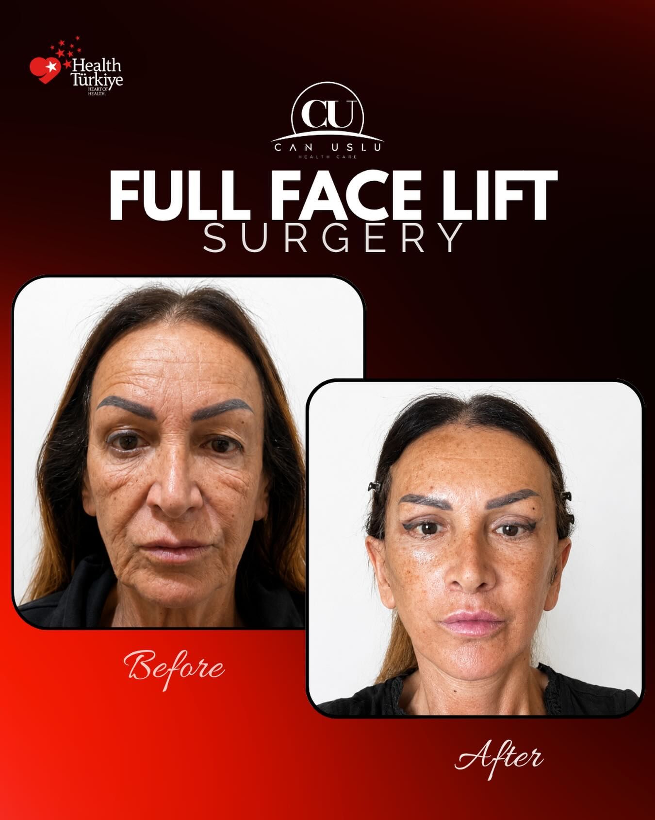Deep Plane Facelift öncesi sonrası