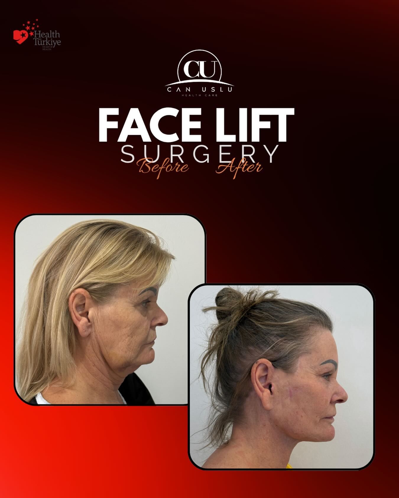 Deep Plane Facelift öncesi sonrası