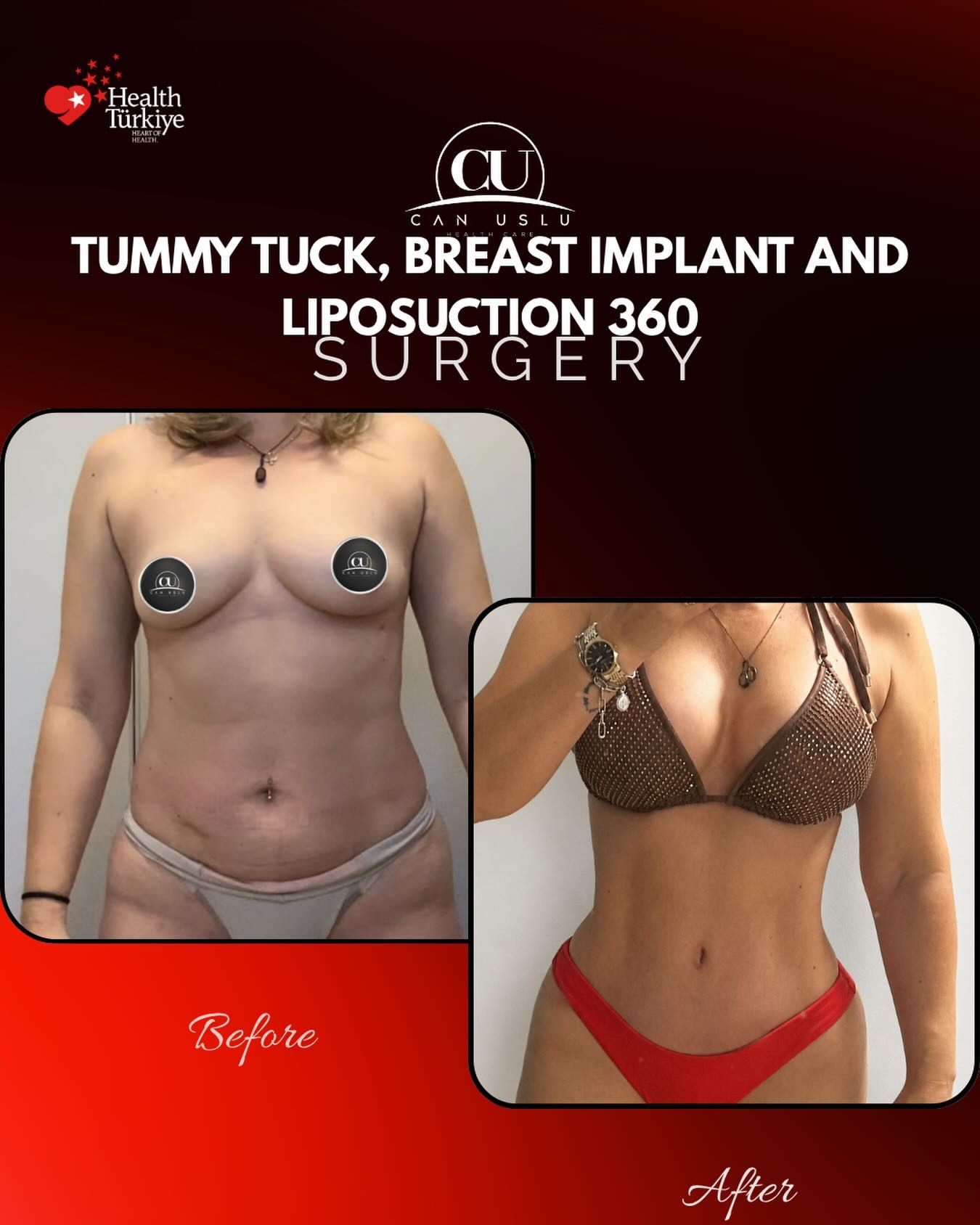 Mommy Makeover öncesi sonrası