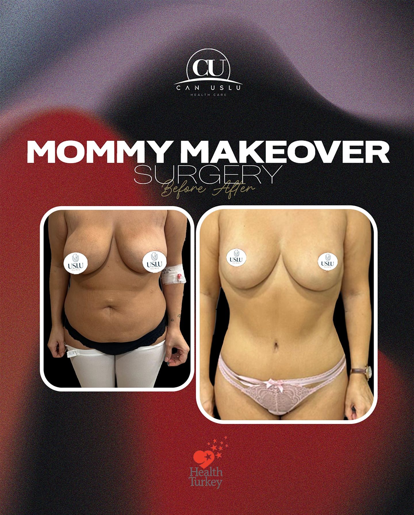 Mommy Makeover öncesi sonrası
